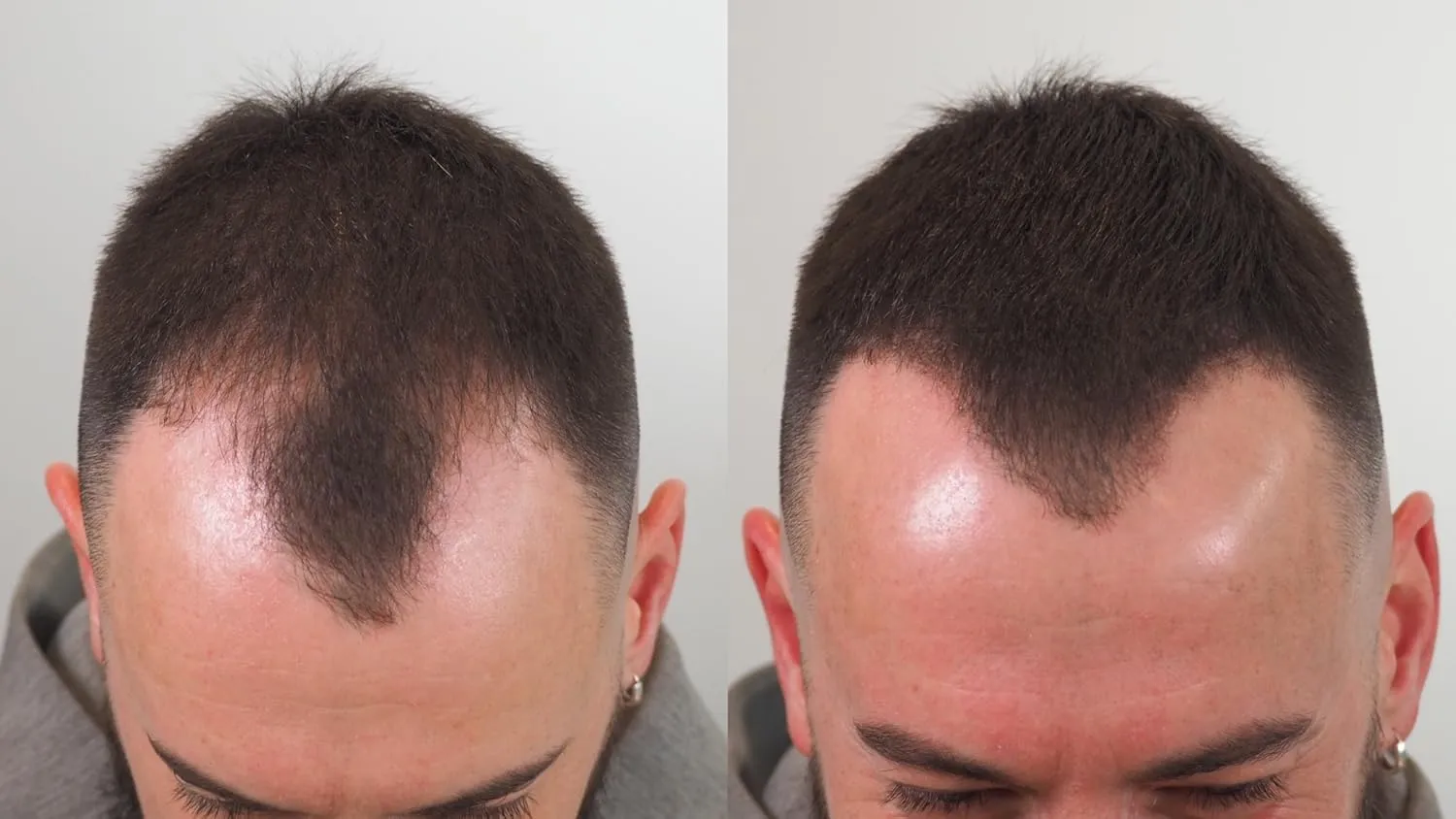 THICK FIBER Hair Building Fibers Review: Do They Actually Hide Thinning Hai 2 THICK FIBER Hair Building Fibers